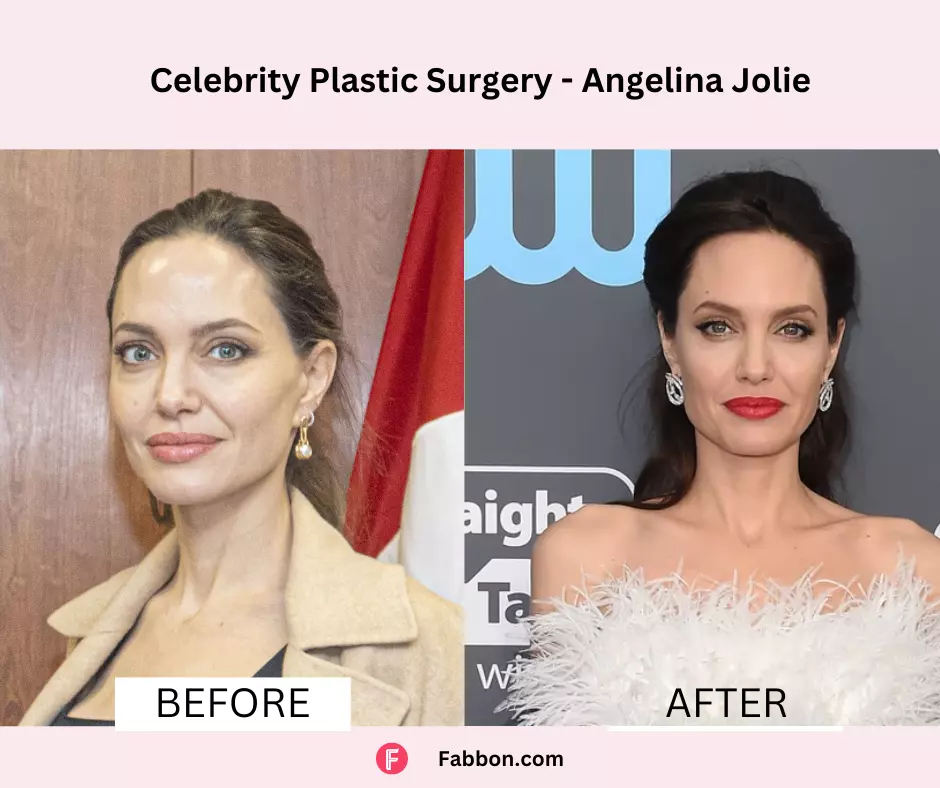 Angelina-Jolie-celebrity-plastic-surgery