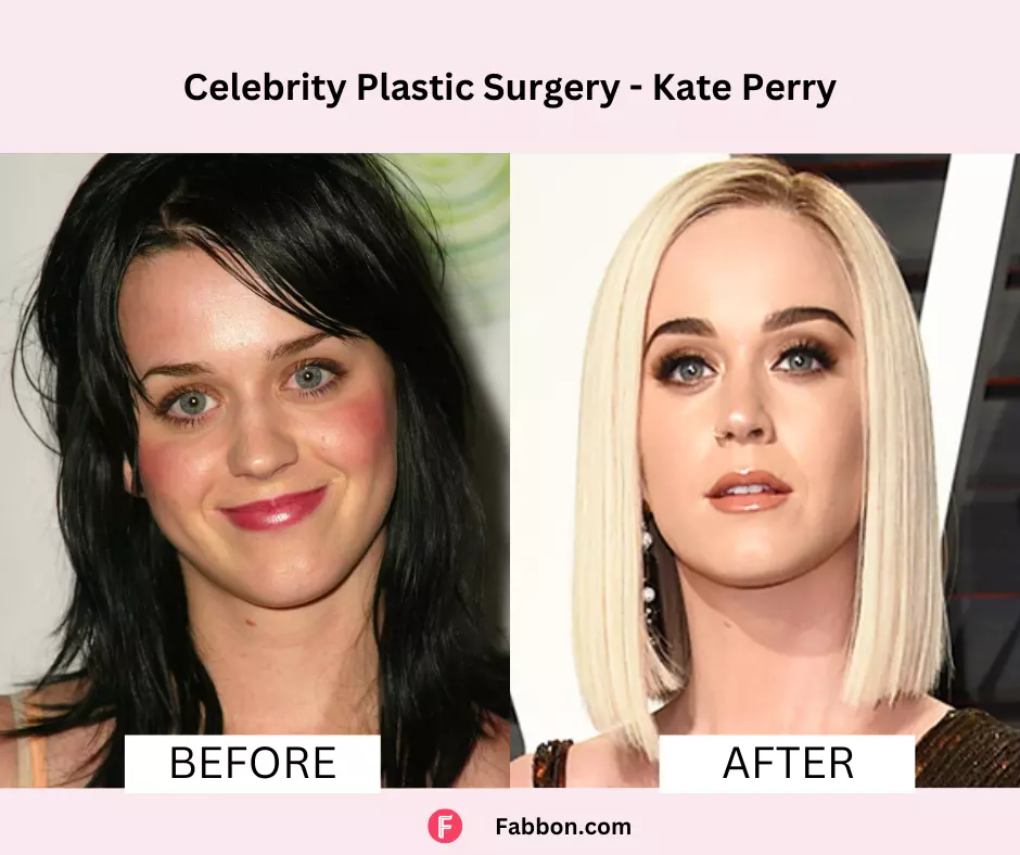 Celebrity plastic surgery procedures - before and after photos