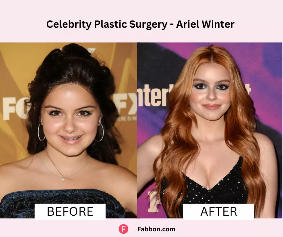 Ariel-Winter-celebrity-plastic-surgery