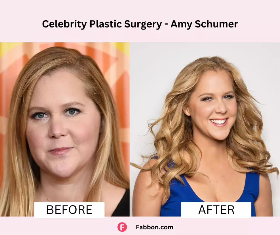 Amy-Schumer-celebrity-plastic-surgery