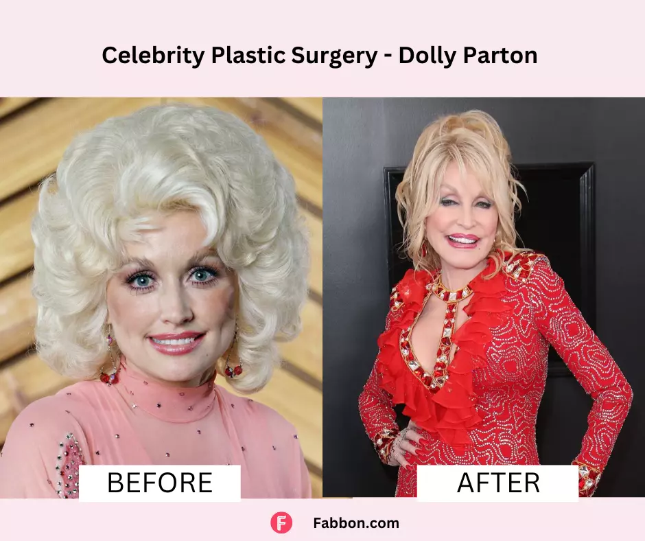 Dolly-Patron-celebrity-plastic-surgery