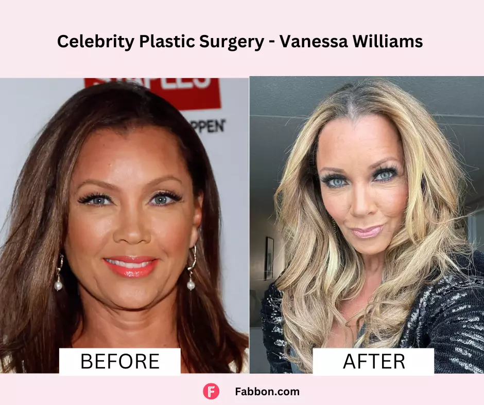 VAnessa-Williams-celebrity-plastic-surgery