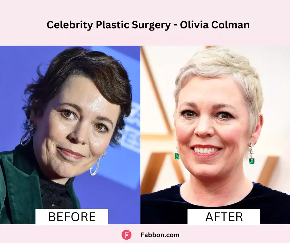 Olivia-Colman-celebrity-plastic-surgery