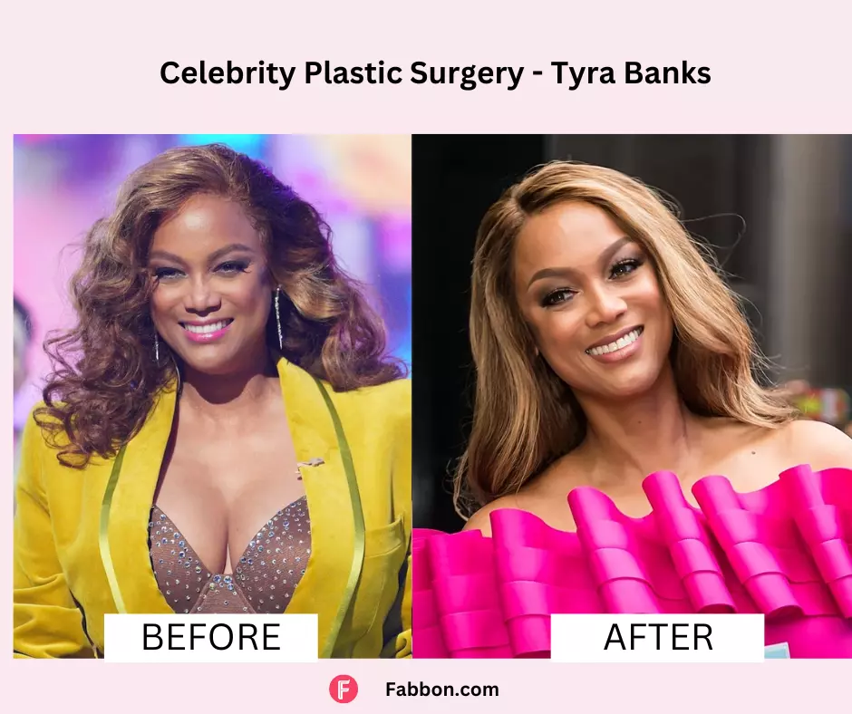 Tyra-Banks-celebrity-plastic-surgery