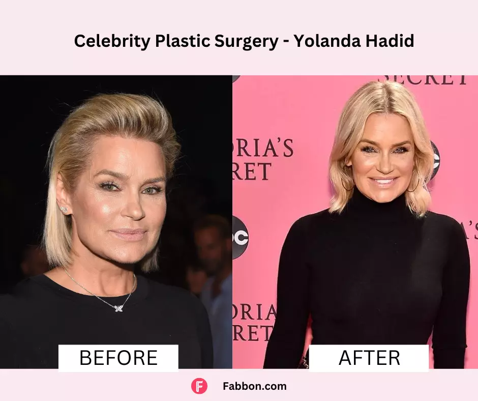 Yolanda-HAdid-celebrity-plastic-surgery