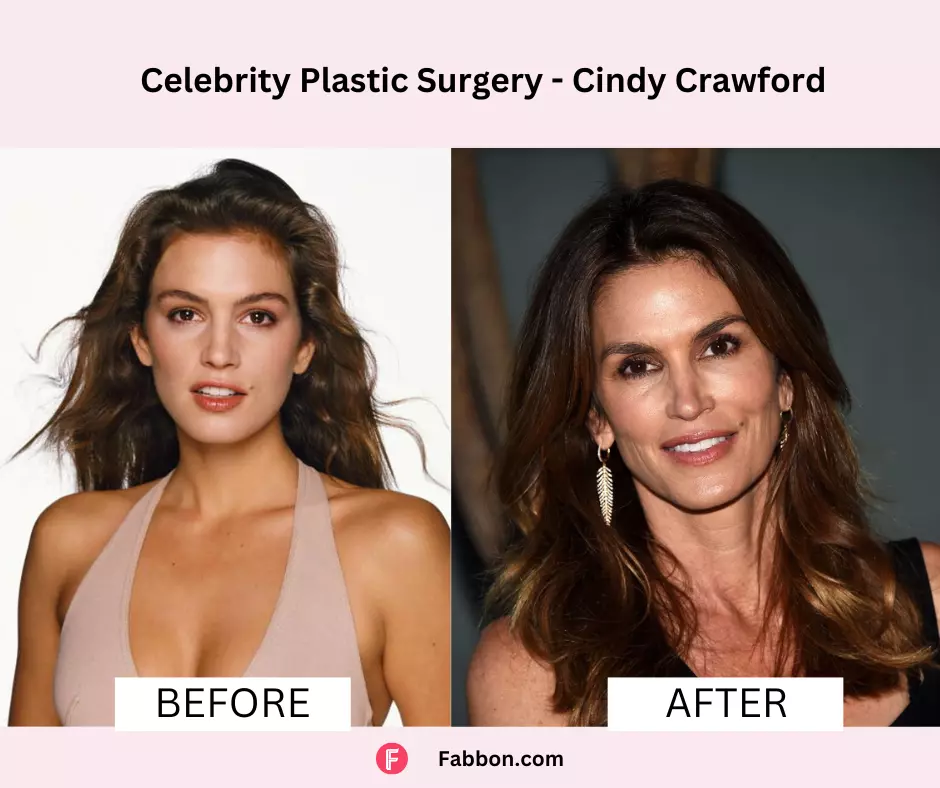 Cindy-Crawford-celebrity-plastic-surgery