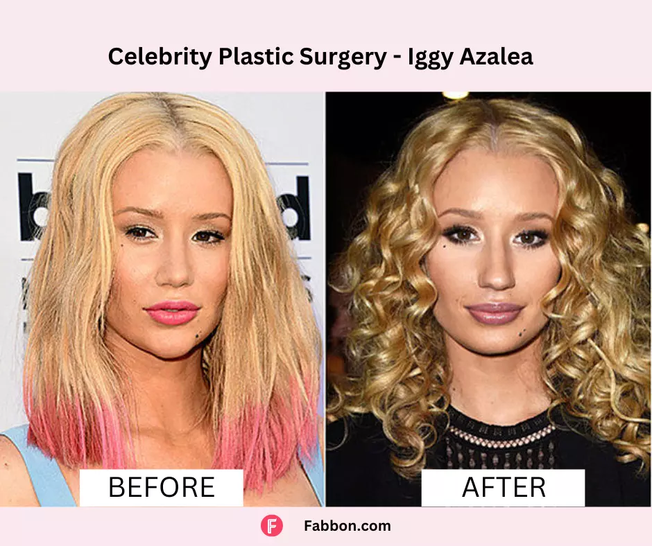 Iggy-Azzalea-celebrity-plastic-surgery