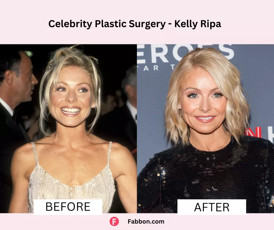 Kelly-Ripa-celeb-plastic-surgery