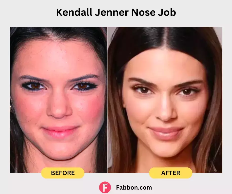 Kendall Jenner-nose-job