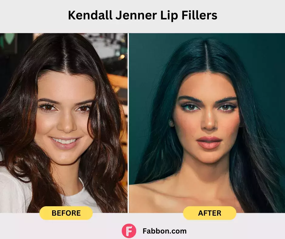 Kendall Jenner-lip-fillers