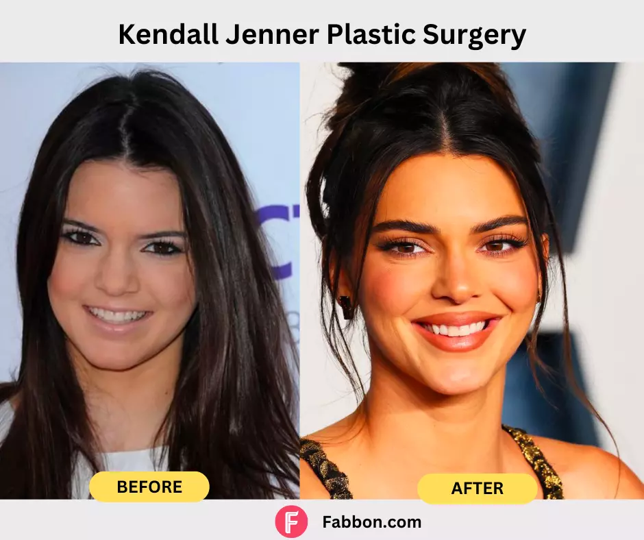 Kendall Jenner-plastic-surgery-before-after