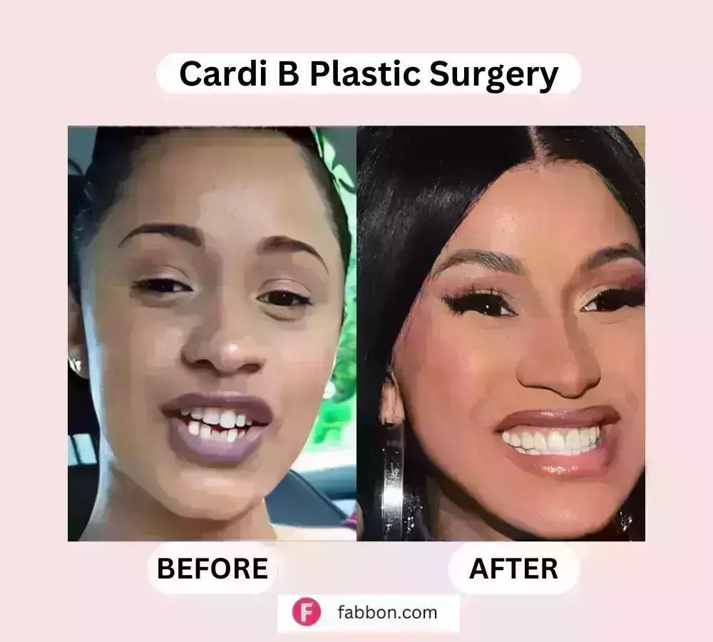 Cardi B Plastic Surgery Full Guide : Before And After Photos | Fabbon