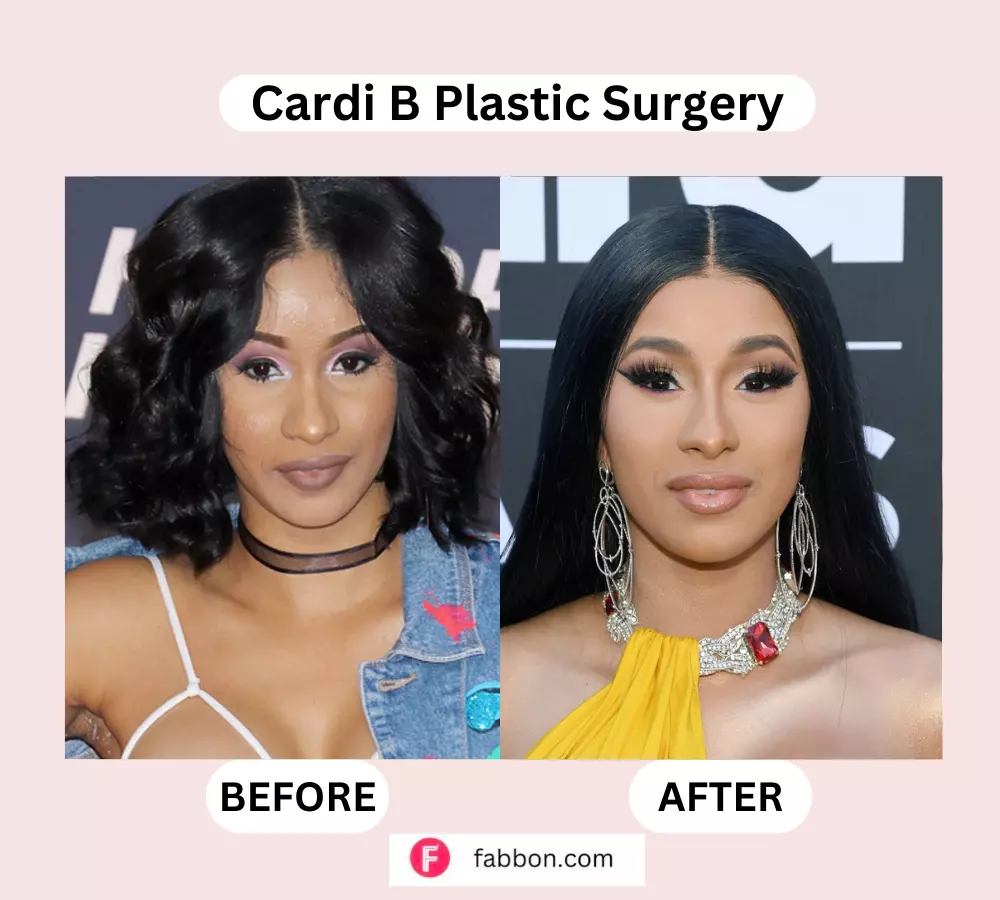 Cardi B Plastic Surgery (2)