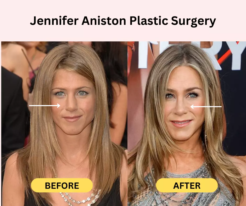 Jennifer-Aniston-Plastic-Surgery-nosejob-rhinoplasthy