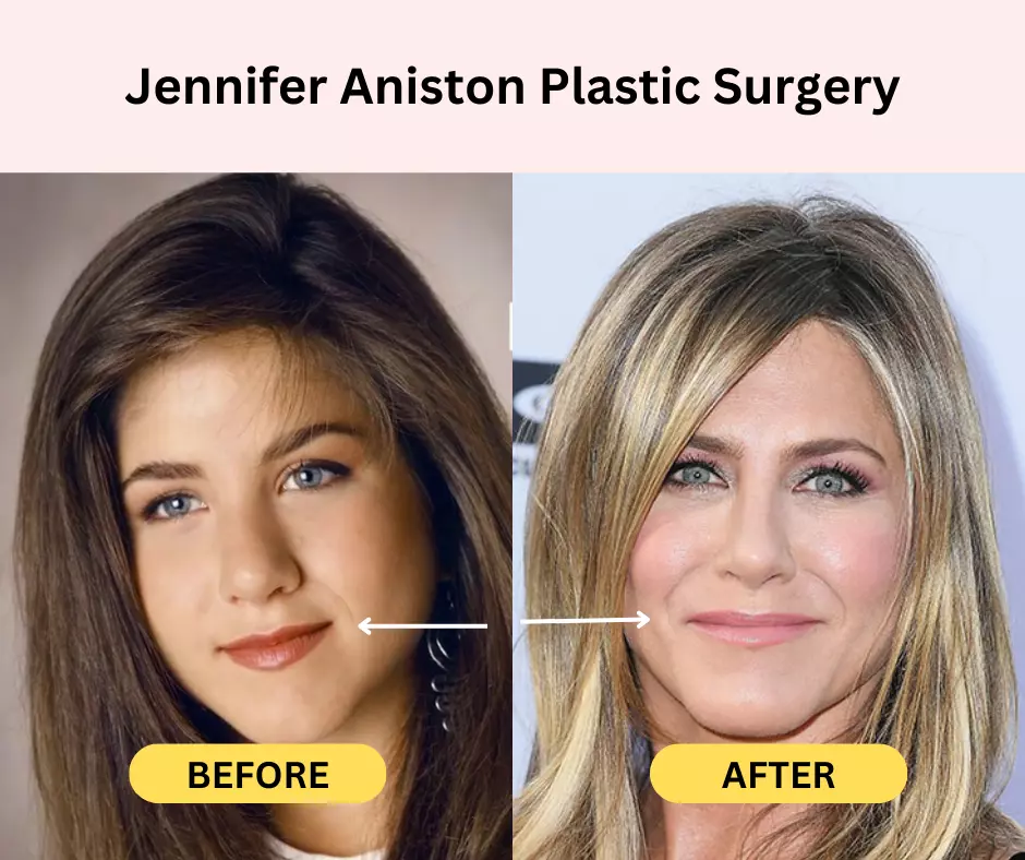 Jennifer-Aniston-Plastic-Surgery-Lip-fillers