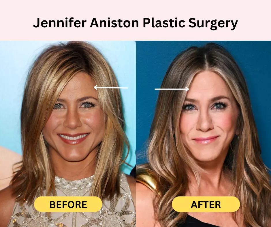 Jennifer-Aniston-Plastic-Surgery-botox