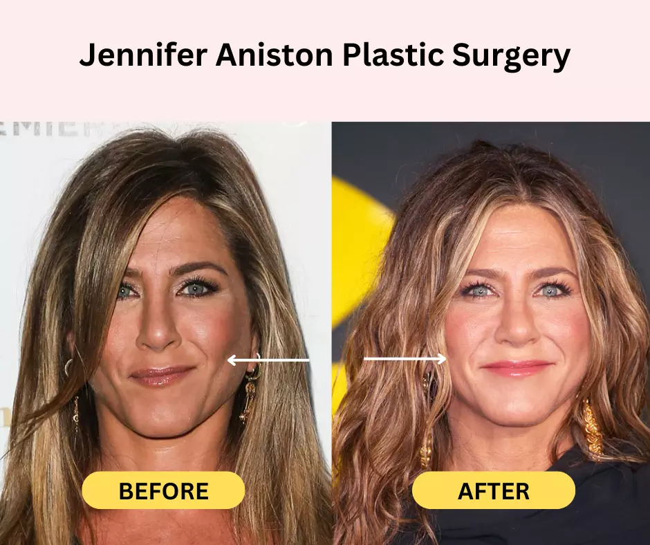 Jennifer-Aniston-Plastic-Surgery-Cheeks-filler