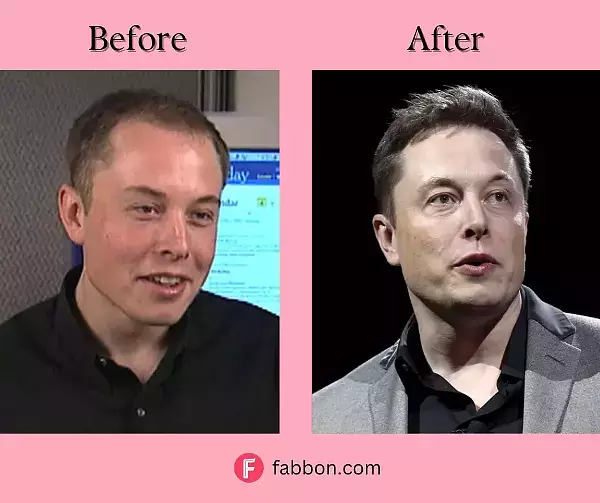 Elon-Musk-FUT-hair-transplant