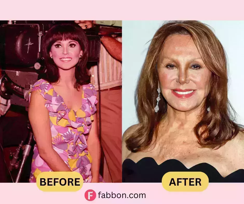 Marlo Thomas Plastic Surgery Secrets Before And After Photos Fabbon