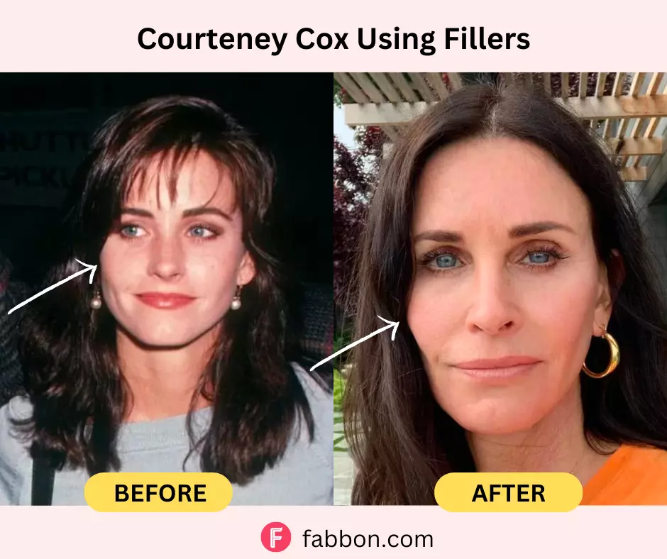courteney-cox-using-fillers