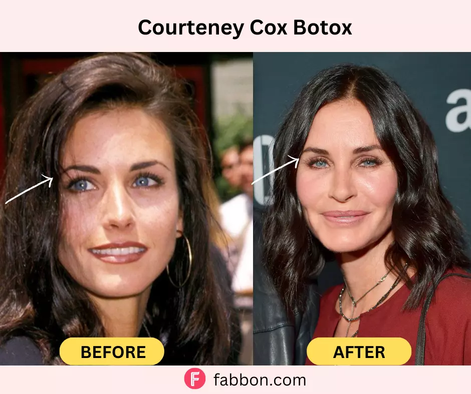 courteney-cox-botox