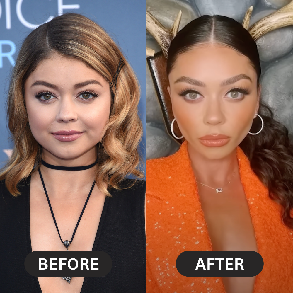 sarah-hyland-buccal-fat-removal