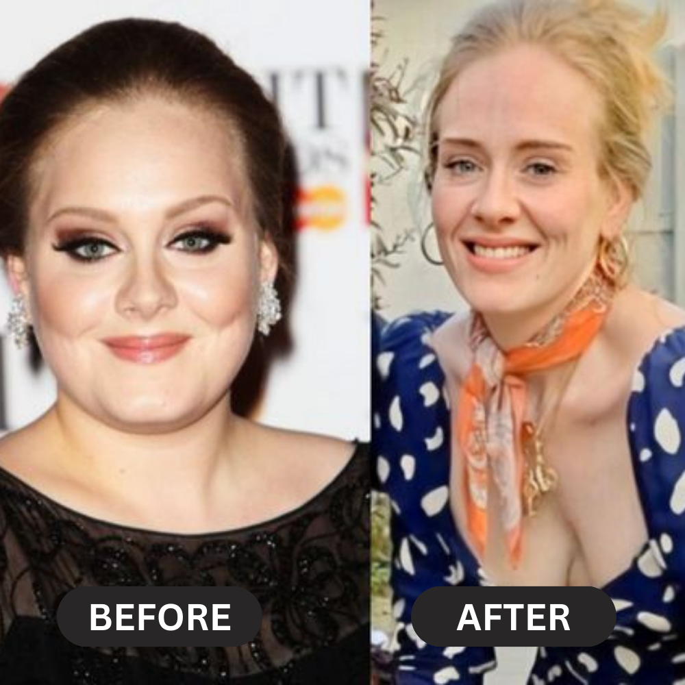 Adele-buccal-fat-removal