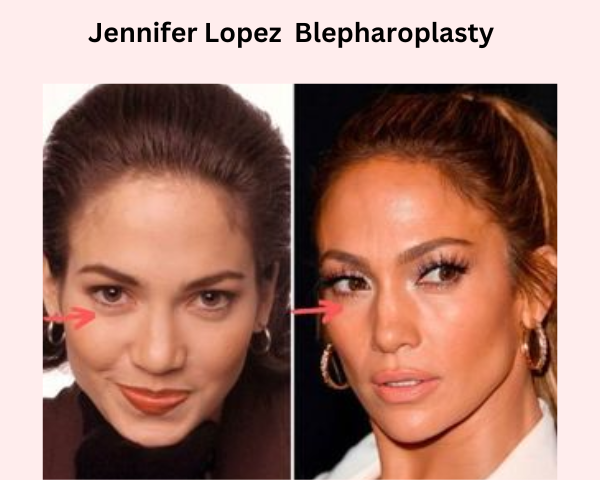 Jennifer-lopez-implants