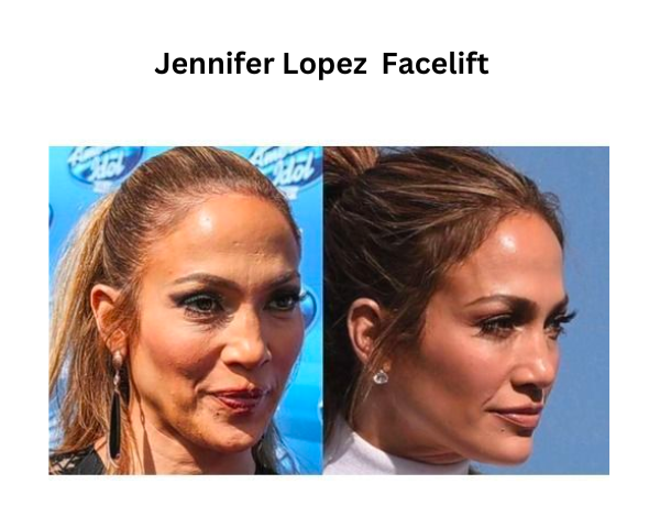 Jennifer-lopez-facelift