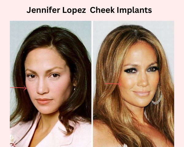 Jennifer-lopez-cheek-implants