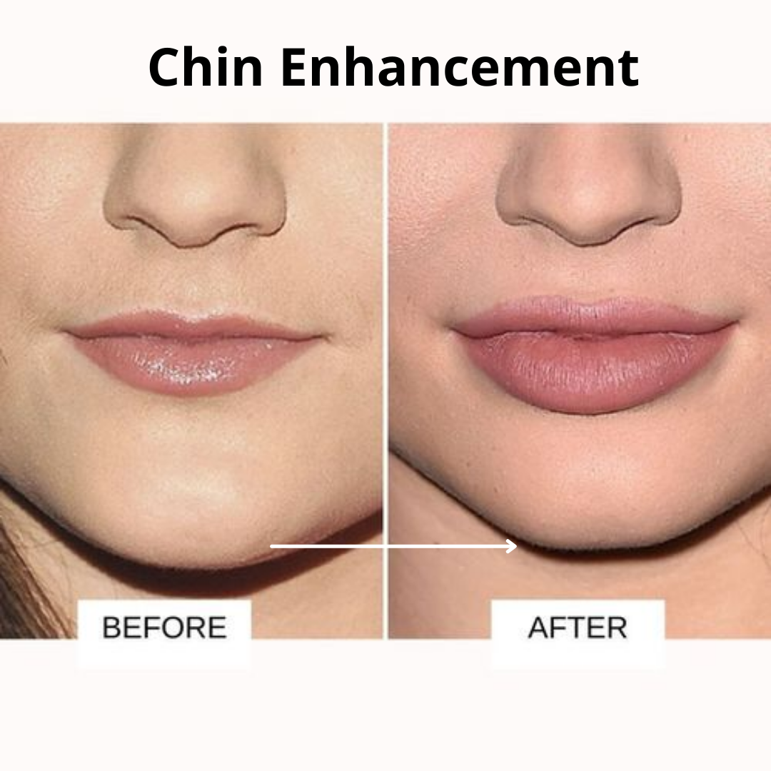 Kylie-jenner-plastic-surgery-chin-enhancement