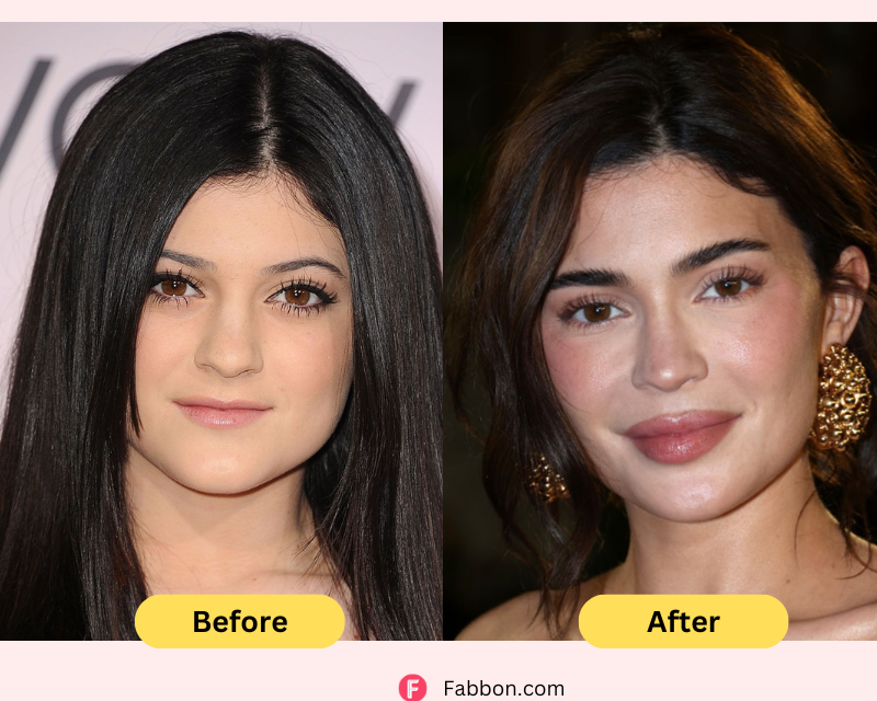Kylie-jenner-before-after-plastic-surgery