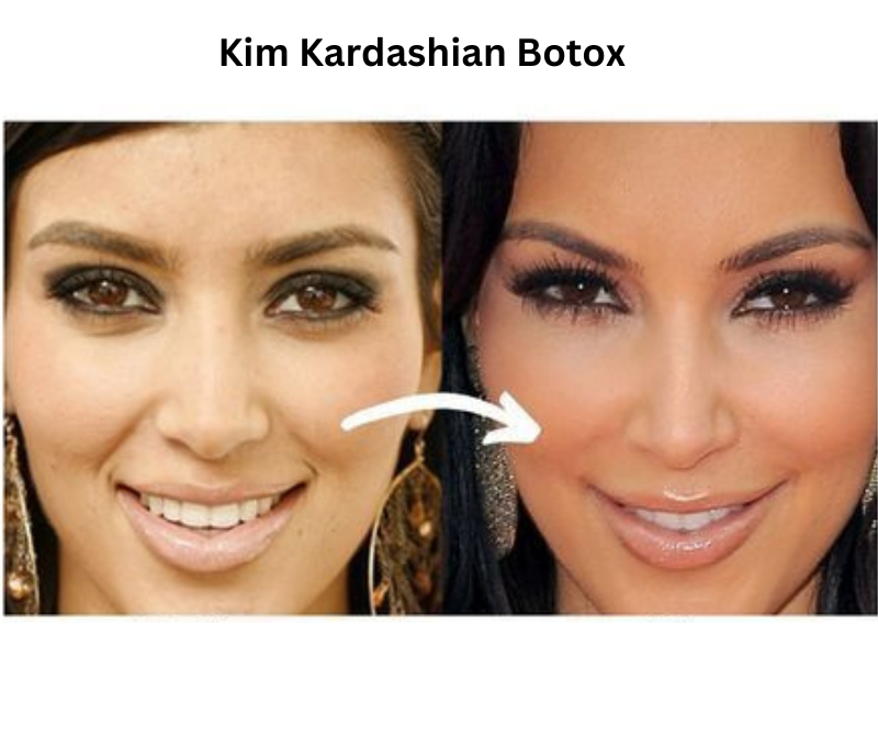 Kim-kardashian-botox