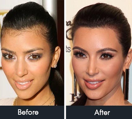 Kim-kardashian-hair-transplant
