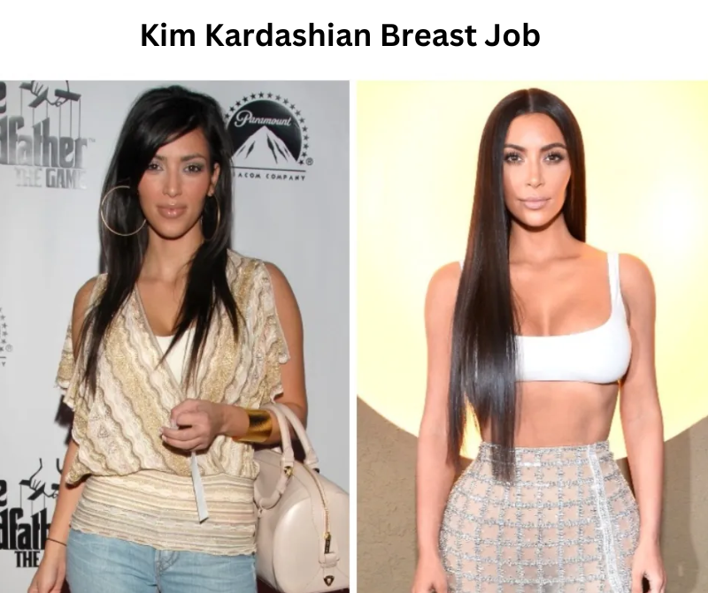 Kim-kardashian-breast-job