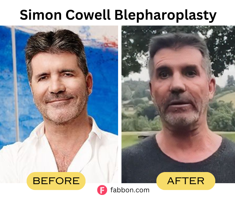 Simon-Cowell-Blepharoplasty 