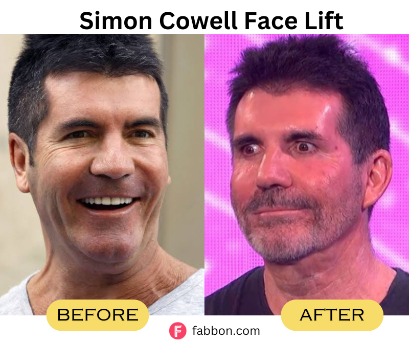 Simon-Cowell-Face-Lift