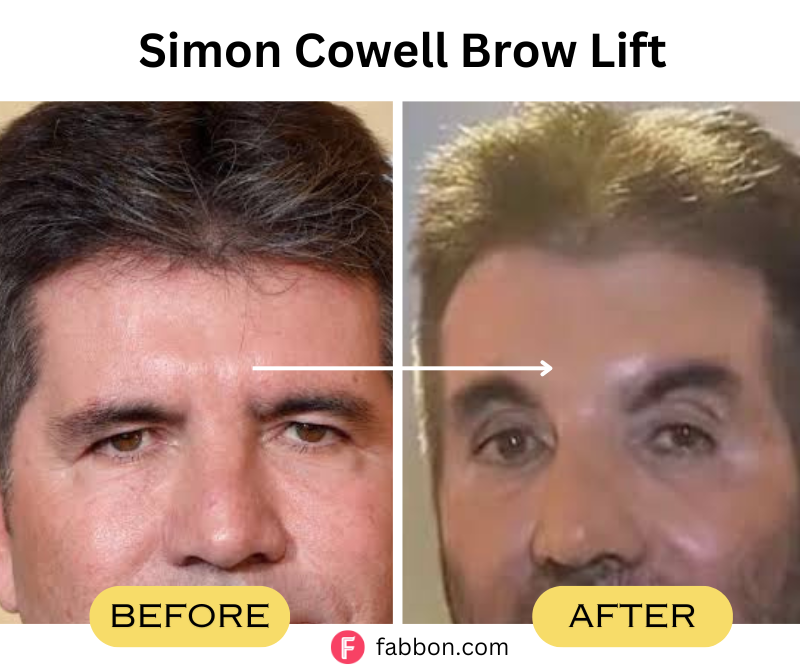 Simon-Cowell-Brow-Lift