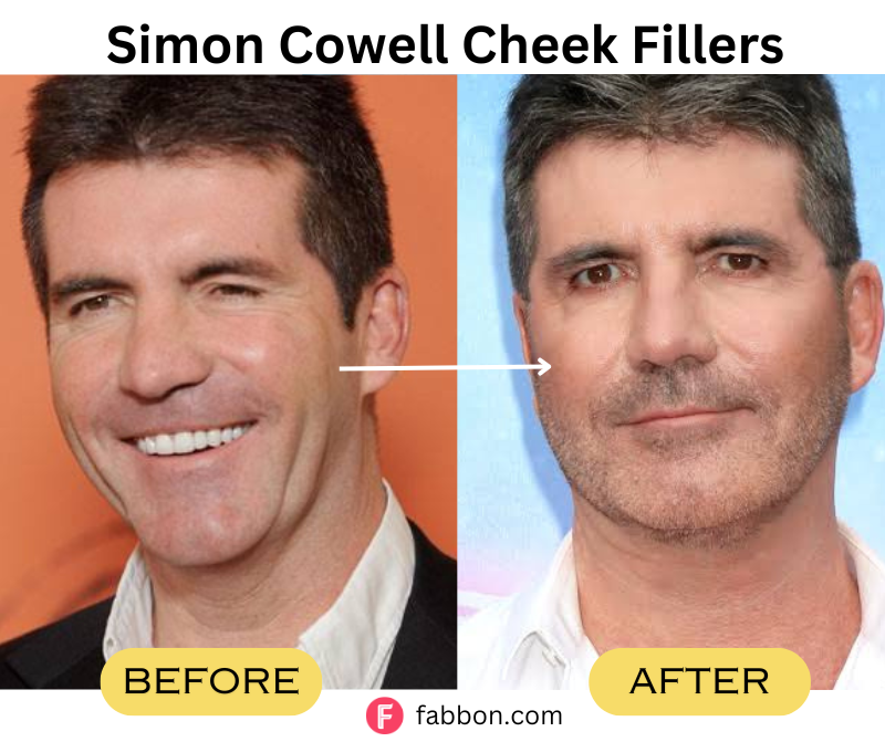 Simon-Cowell-Cheek-Fillers