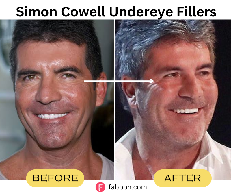 Simon-Cowell-Undereye-Fillers