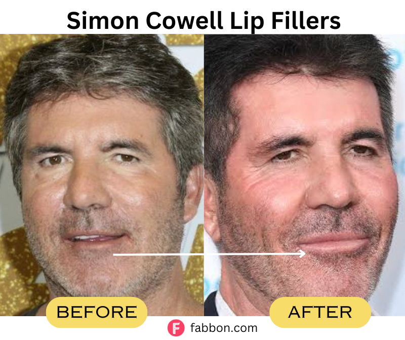 Simon-Cowell-Lip-Fillers