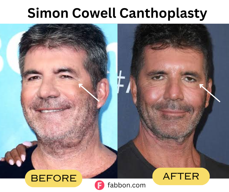  Simon-Cowell-Canthoplasty 