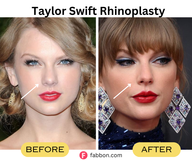 Taylor-Swift-Rhinoplasty