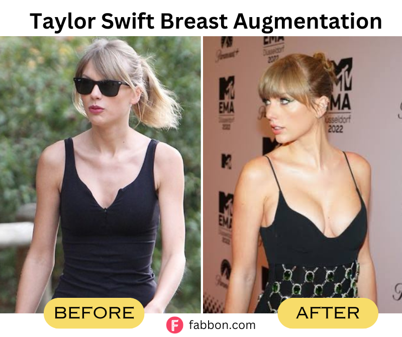 Taylor-Swift-Breast-Augmentation