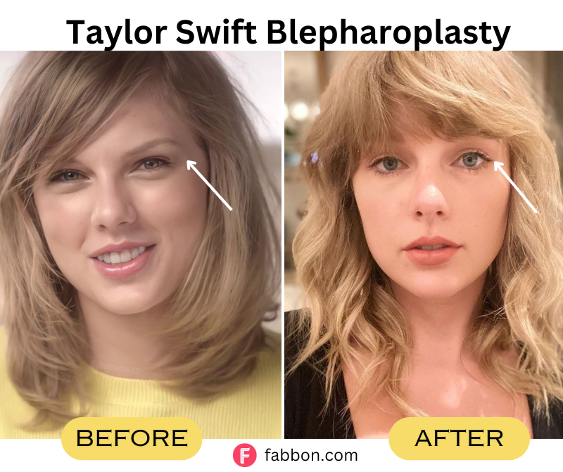 Taylor-swift-Blepharoplasty 