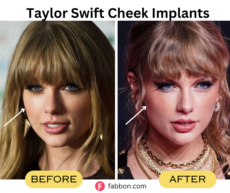Taylor-swift-cheek-implants