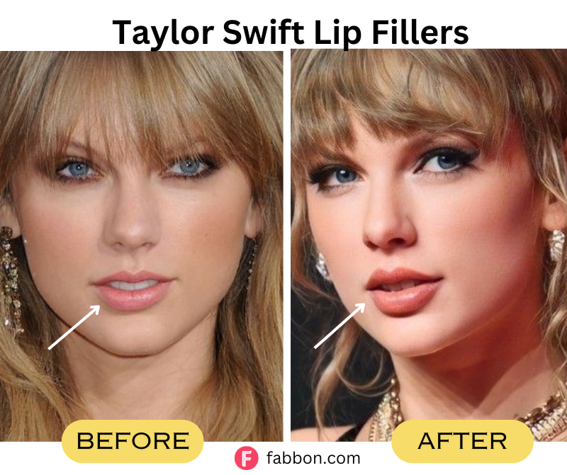 Taylor-swift-lip-fillers