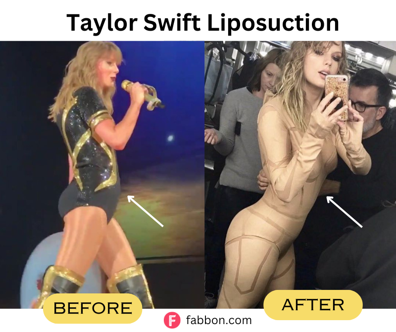 Taylor-swift-lipsuction