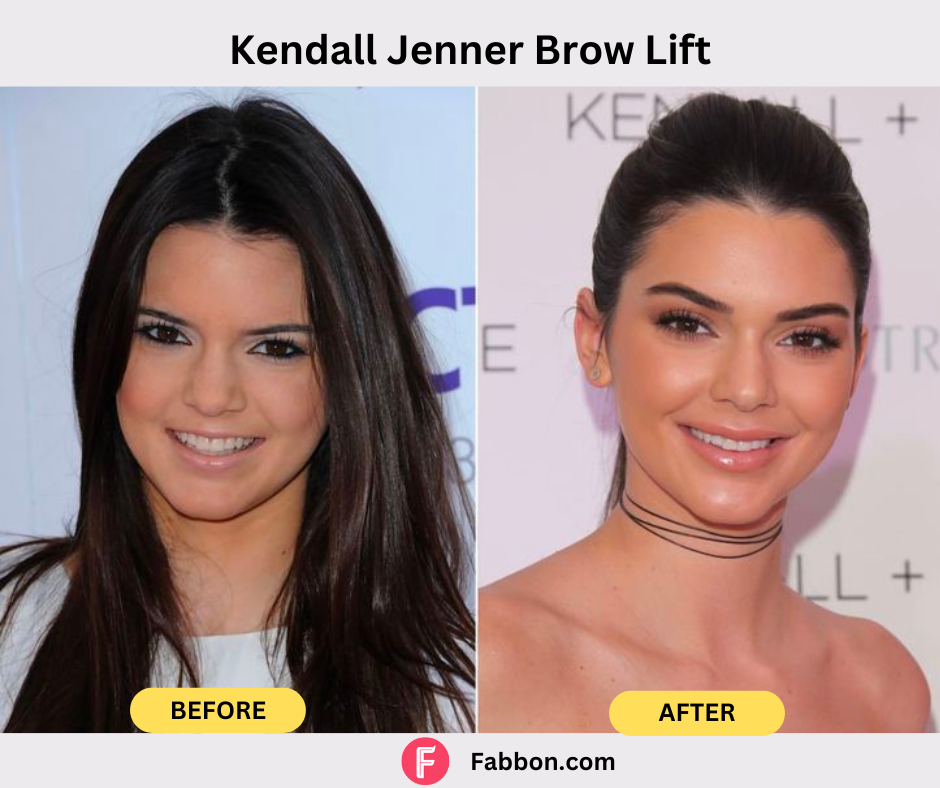 kendall-jenner-brow-lift