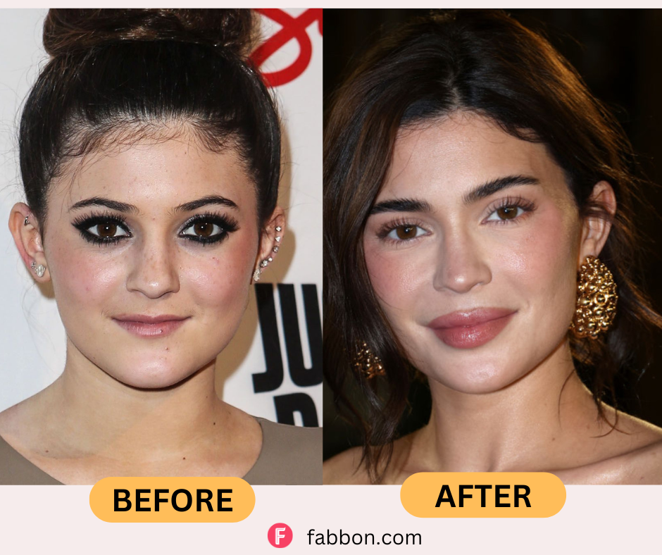 kylie-jenner-plastic-surgery -before-after